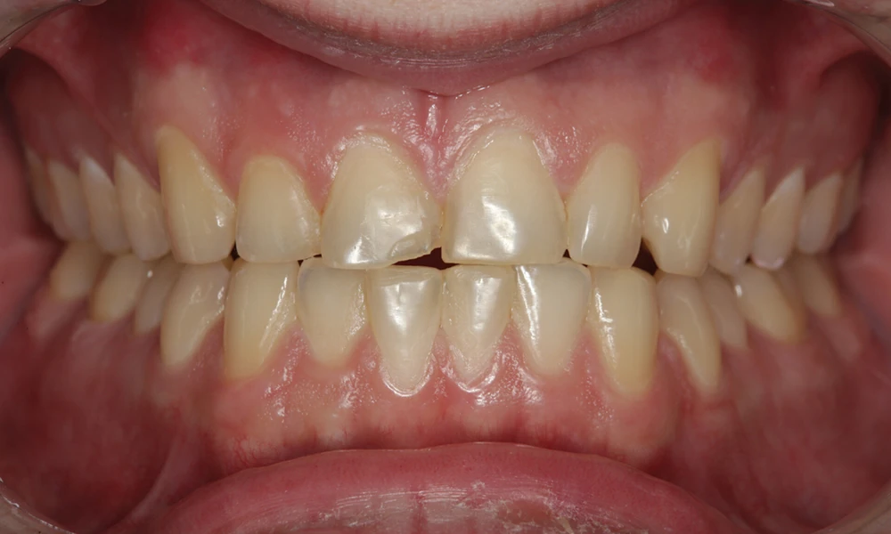 When Can A Single Front Tooth Restoration Be Repaired Instead Of Replaced?